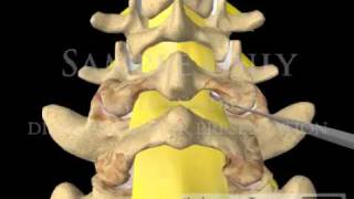 Lumbar Spine Laminectomy courtroom videos [upl. by Kaliski]