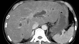 HBP C7 Cholangitis on CT [upl. by Ola]