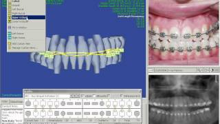 SureSmile Software Demo [upl. by Hanala]