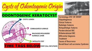 Odontogenic Keratocyst HISTOPATHOLOGY TREATMENT  Causes of recurrence DETAILED part 2 Time tag [upl. by Burnie732]