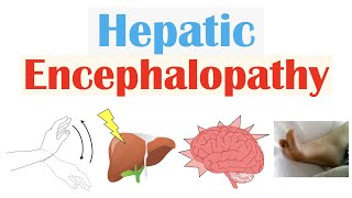 Hepatic Encephalopathy  Pathophysiology Triggers Signs amp Symptoms Diagnosis Treatment [upl. by Ecnerwaled]