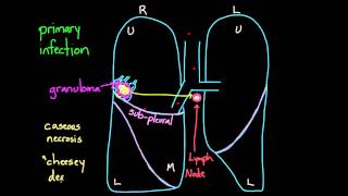 Primary and Secondary TB [upl. by Eiduam]