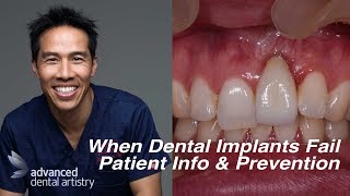 Dental Implant Failures  Patient Information and Prevention [upl. by Ninnetta]