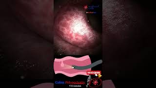 Coloscopy  Colon Polyp Resection  Polypectomy [upl. by Yentnuoc181]