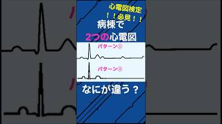 この2つの徐脈、房室ブロック？SSS part17 心電図検定 看護師 心電図 [upl. by Lane]