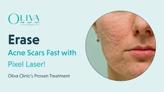 Erase Acne Scars Fast with Pixel Laser  Oliva Clinic’s Proven Treatment [upl. by Tsenre]