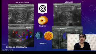 INTUSSUSCEPTION OR VOLVULUS [upl. by Ettesil]