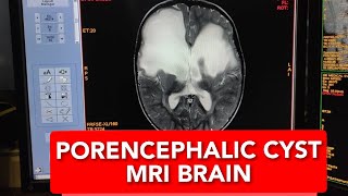 How to Read MRI Brain of 2 years Baby Diagnosing Large Porencephalic Cysts in English [upl. by Bay]