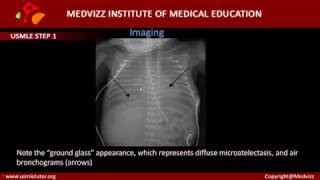 Respiratory Distress Syndrome in Neonates Hyaline Membrane Disease [upl. by Malaspina923]