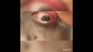 Watch at your own risk Mucus Eye Fishing Syndrome Eye Gunk Removal [upl. by Naghem70]