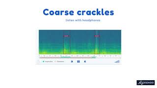 Lung sounds  coarse crackles [upl. by Valerle]