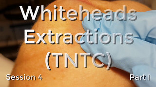 Whiteheads Extraction TNTC  Session 4  Part I [upl. by Ayahc976]