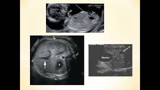 Fetal abdominal cyst [upl. by Anitap]