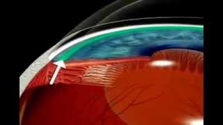 What is Glaucoma Explained using Animation [upl. by Ahseid]