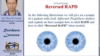 Reversed RAPD explained [upl. by Tace]