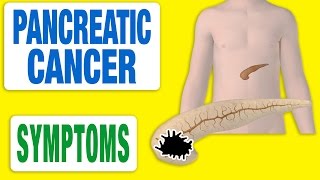 Pancreatic Cancer  All Symptoms [upl. by Thera319]