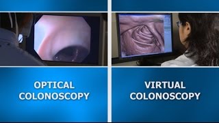 Colonoscopy screening Virtual vs optical colonoscopy [upl. by Alidis370]