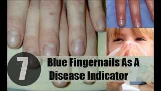 7 Blue Fingernails As A Disease Indicator [upl. by Aicatsanna]