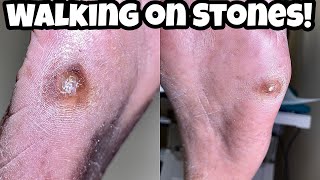 How To Get Rid Of a Stone Callus [upl. by O'Rourke]