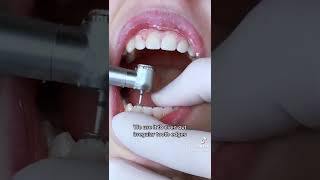 Enameloplasty  Filing Edges of Your Teeth w TheBracesDoc [upl. by Conrado]