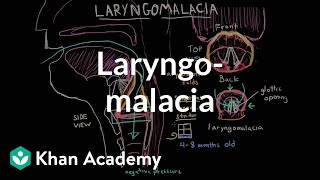 Laryngomalacia  Respiratory system diseases  NCLEXRN  Khan Academy [upl. by Laamaj]