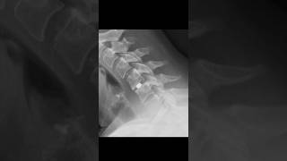 C56 disc arthroplasty xraycervicalspine [upl. by Constant]