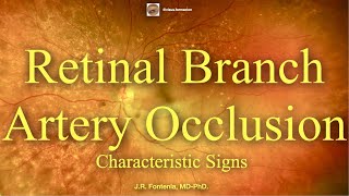 Branch Retinal Artery Occlusion Characteristic Signs [upl. by Leibrag]