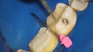 cracked tooth and crown preparartion [upl. by Rodolphe]