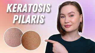 Bästa behandlingen mot Keratosis Pilaris [upl. by Mae736]