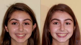 Braces Before and After with Reshaping of Front Teeth [upl. by Fransisco470]