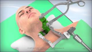 CS1600L Cervical Retractor Animation [upl. by Anika]