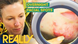 Dr Emma Investigates A Young Womans Sudden Facial Spots  The Bad Skin Clinic [upl. by Aisinut]