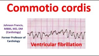 Commotio cordis [upl. by Fernande12]