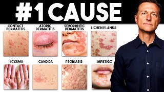 The MOST Common Deficiency in All Skin Diseases Dermatitis [upl. by Cheung]