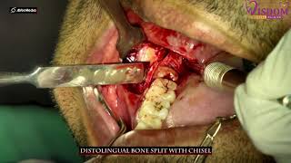 Mesioangular third molar disimpaction by Lingual Split [upl. by Citarella]