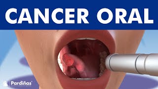 El CÁNCER ORAL  Causas síntomas y tipos de tumores en la boca © [upl. by Nyrat]