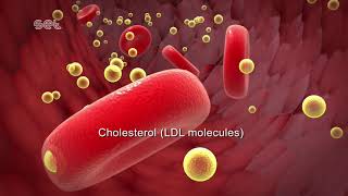 Arteriosclerosis [upl. by Helm465]