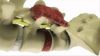 Transforaminal Lumbar Interbody Fusion TLIF Surgery  DePuy Back ampSpine [upl. by Craggie962]