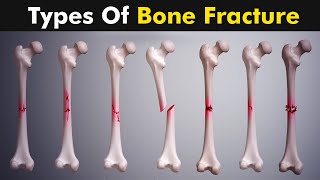 Common types of Bone fracture  3D animation [upl. by Akemaj]