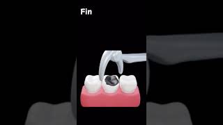 Tooth Extraction procedure bestdentalclinic bestcosmeticdentalclinic dentalcare dentalclinic [upl. by Asille]