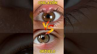 Chalazión vs Orzuelo orzuelo chalazion Tratamiento oftalmologia infeccionOcular [upl. by Eniale]