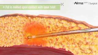 Laser Liposuction [upl. by Attiuqihc]