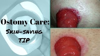 Ostomy care Healing the Skin around the Stoma [upl. by Vaughan]