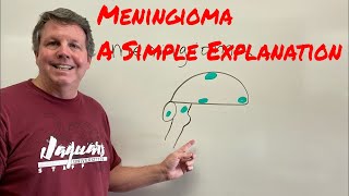 Meningioma A Simple Explanation [upl. by Grey68]