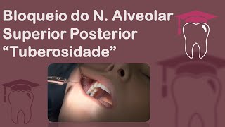 Anestesia da Tuberosidade  Bloqueio do Nervo Alveolar Superior Posterior [upl. by Loreen]