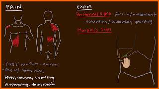 Acute Cholecystitis 23 [upl. by Eynaffit]