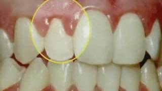 Periodontal Disease amp Treatment [upl. by Rome]