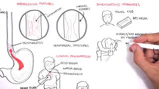 GORD GERD Gastro Oesophageal Reflux Disease  Overview pathophysiology treatment [upl. by Ellwood]