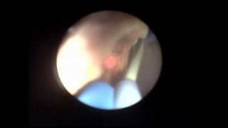 Rigid ureteroscopy and laser stone fragmentationmpg [upl. by Anahsirk]