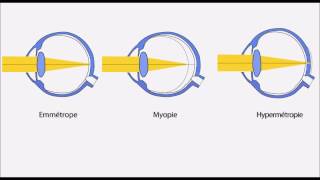 Amétropie hypermétropie myopie astigmatisme presbytie [upl. by Coltun]